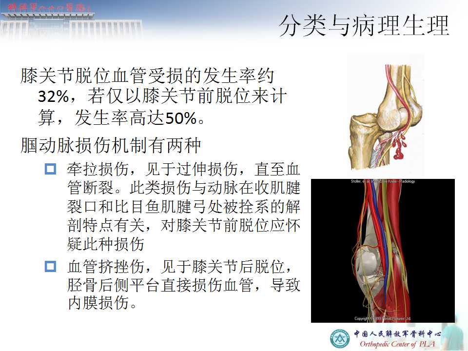 膝关节多韧带损伤的治疗要点