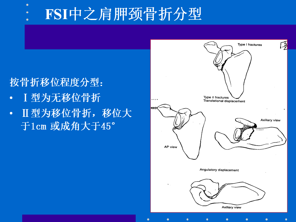 浮肩损伤的应用解剖及治疗策略