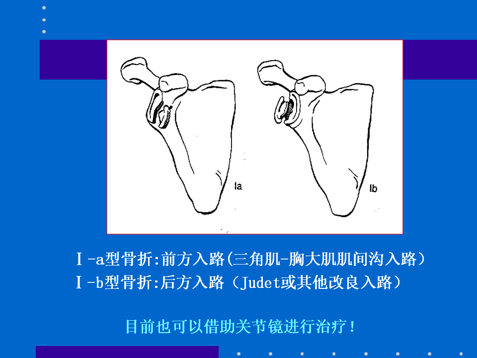 浮肩损伤的应用解剖及治疗策略