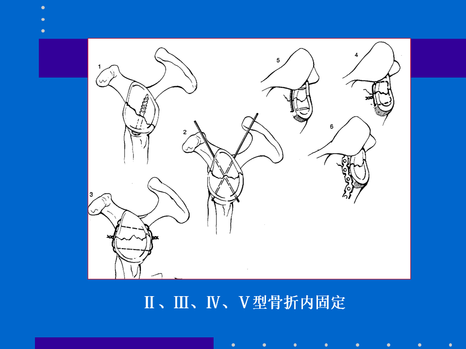 浮肩损伤的应用解剖及治疗策略