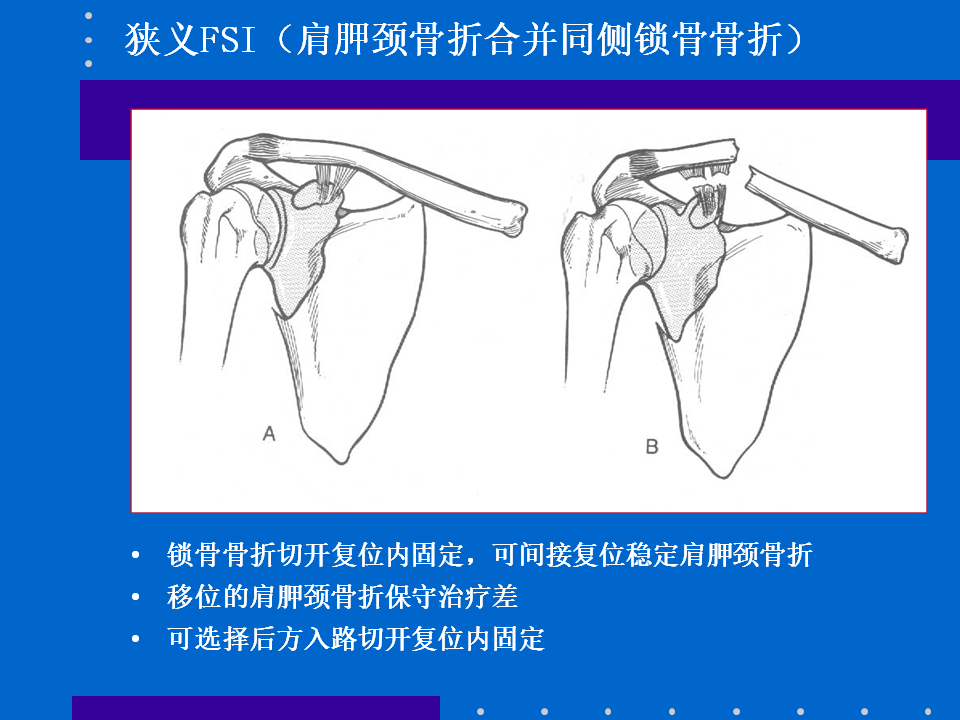 浮肩损伤的应用解剖及治疗策略