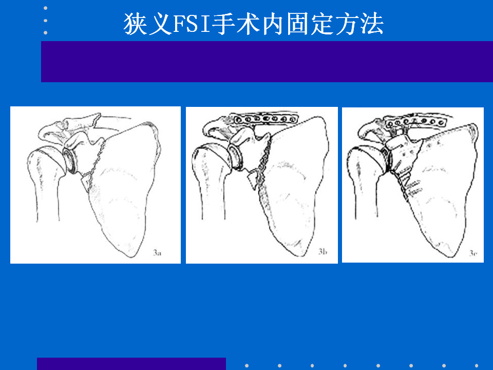 浮肩损伤的应用解剖及治疗策略