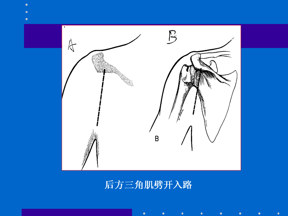 浮肩损伤的应用解剖及治疗策略