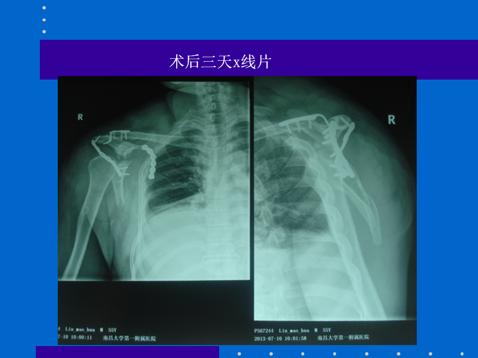 浮肩损伤的应用解剖及治疗策略