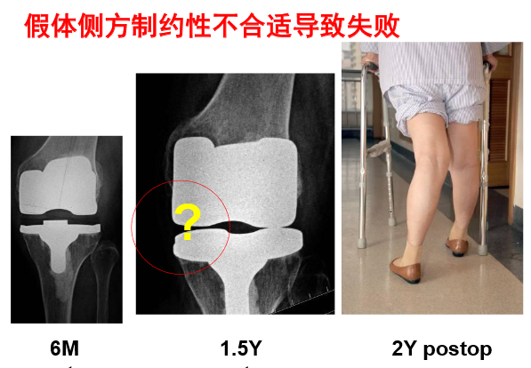 膝关节置换术如何正确选择假体？