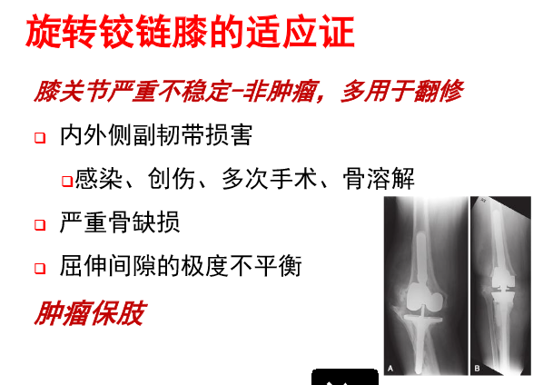 膝关节置换术如何正确选择假体？