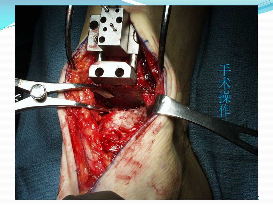 踝关节融合和置换的手术要点