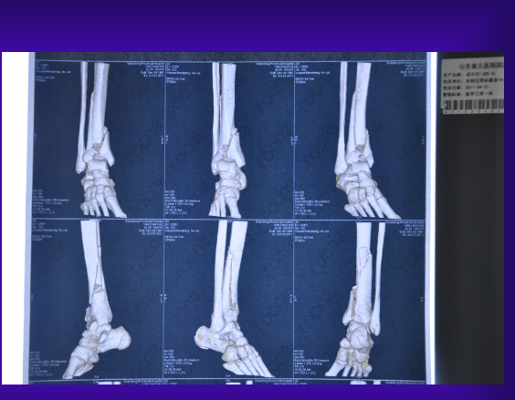 如何正确选择Pilon骨折的治疗方法？