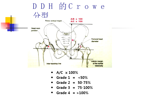 成人DDH的人工髋关节置换术