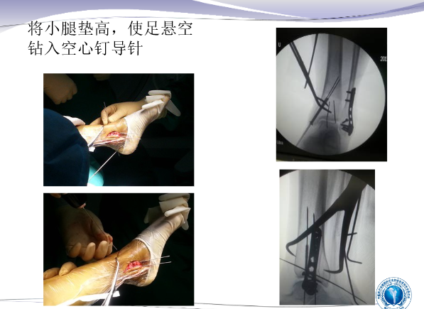 踝关节后外侧及外侧入路的手术技巧及指征
