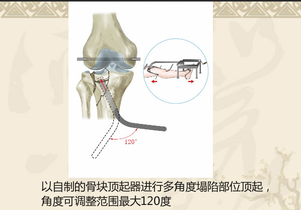双反牵引闭合复位微创治疗胫骨平台骨折