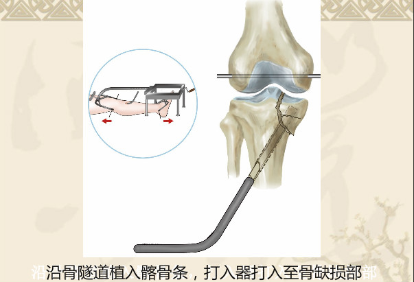 双反牵引闭合复位微创治疗胫骨平台骨折