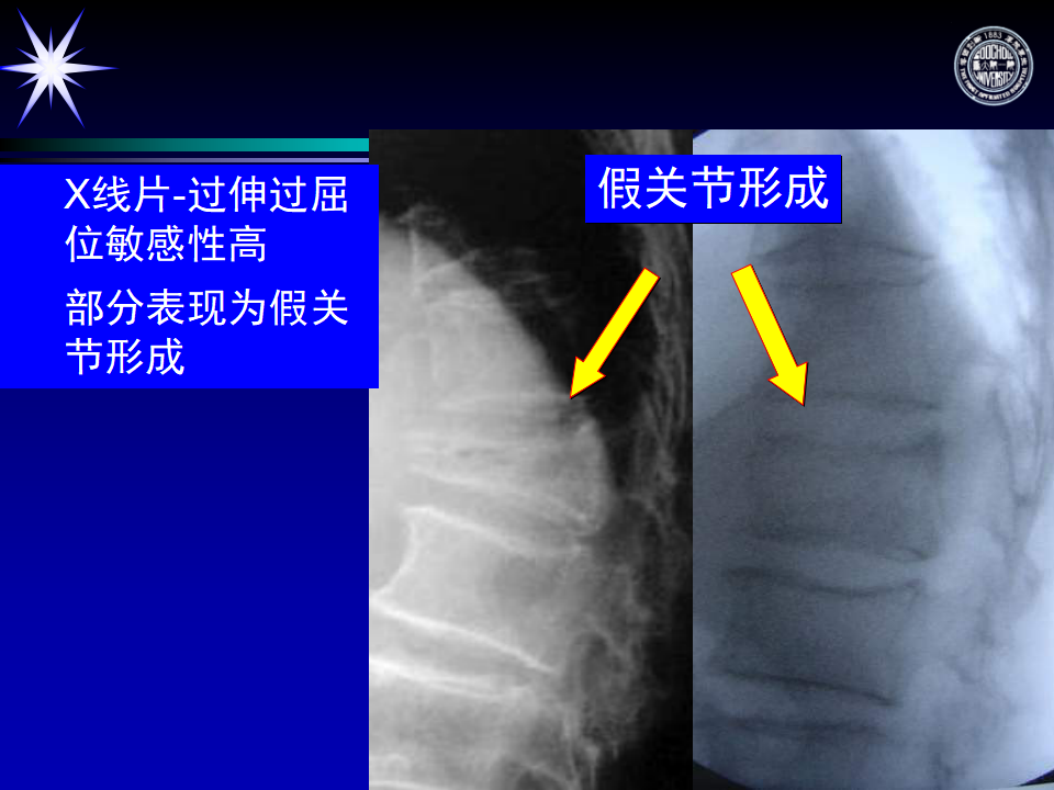 骨质疏松性胸腰椎骨折骨不连的诊疗要点
