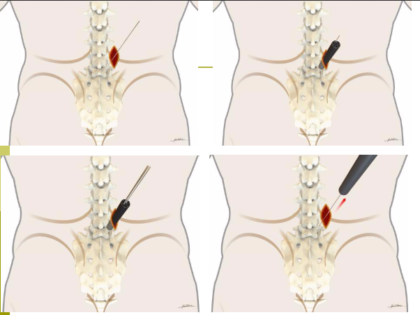 经皮椎弓根螺钉操作的X射线防护及植入技巧