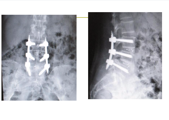 经皮椎弓根螺钉操作的X射线防护及植入技巧