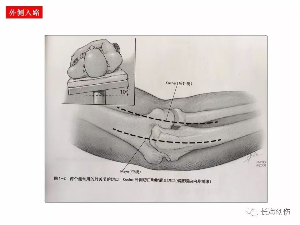 如何做好肘关节手术，先看看这篇解剖和手术入路！