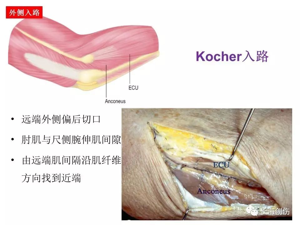 如何做好肘关节手术，先看看这篇解剖和手术入路！