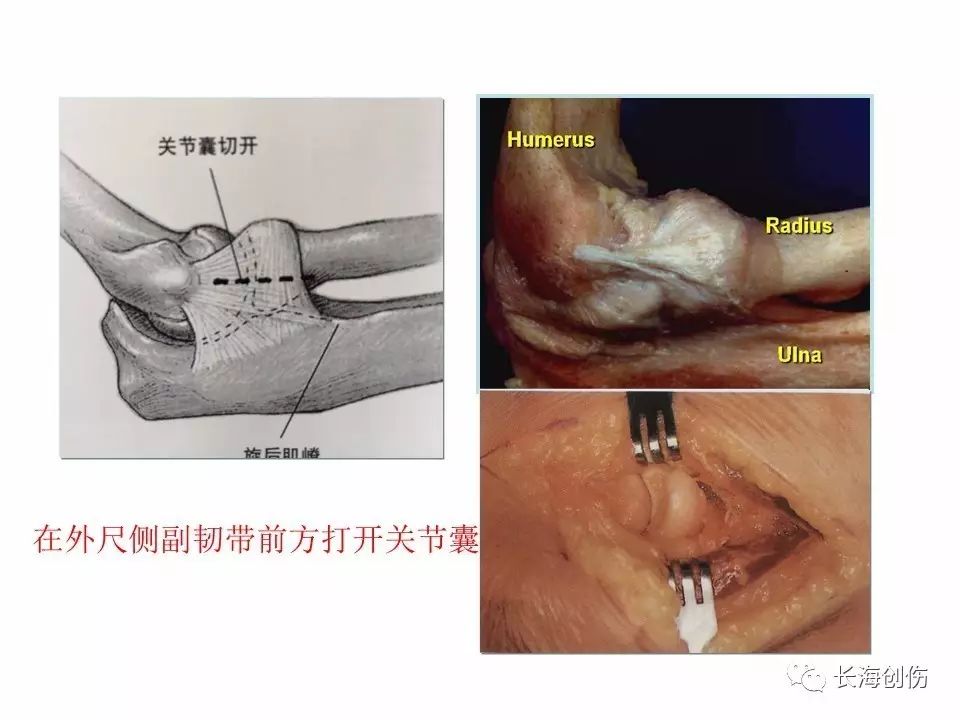 如何做好肘关节手术，先看看这篇解剖和手术入路！