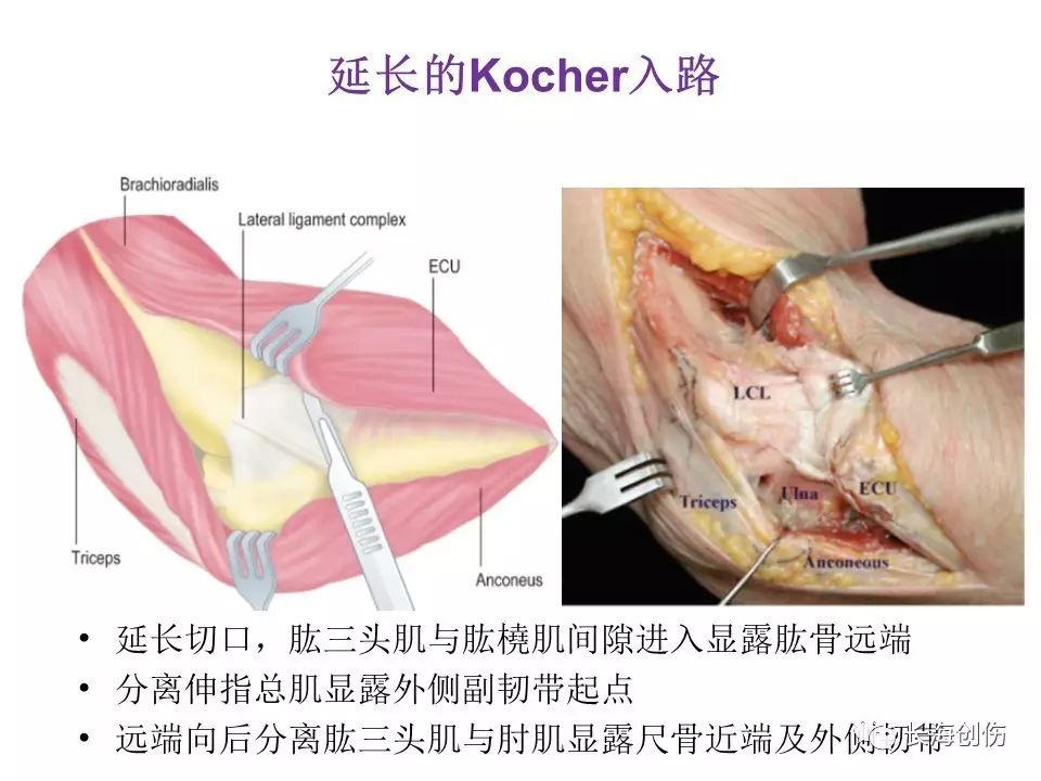 如何做好肘关节手术，先看看这篇解剖和手术入路！