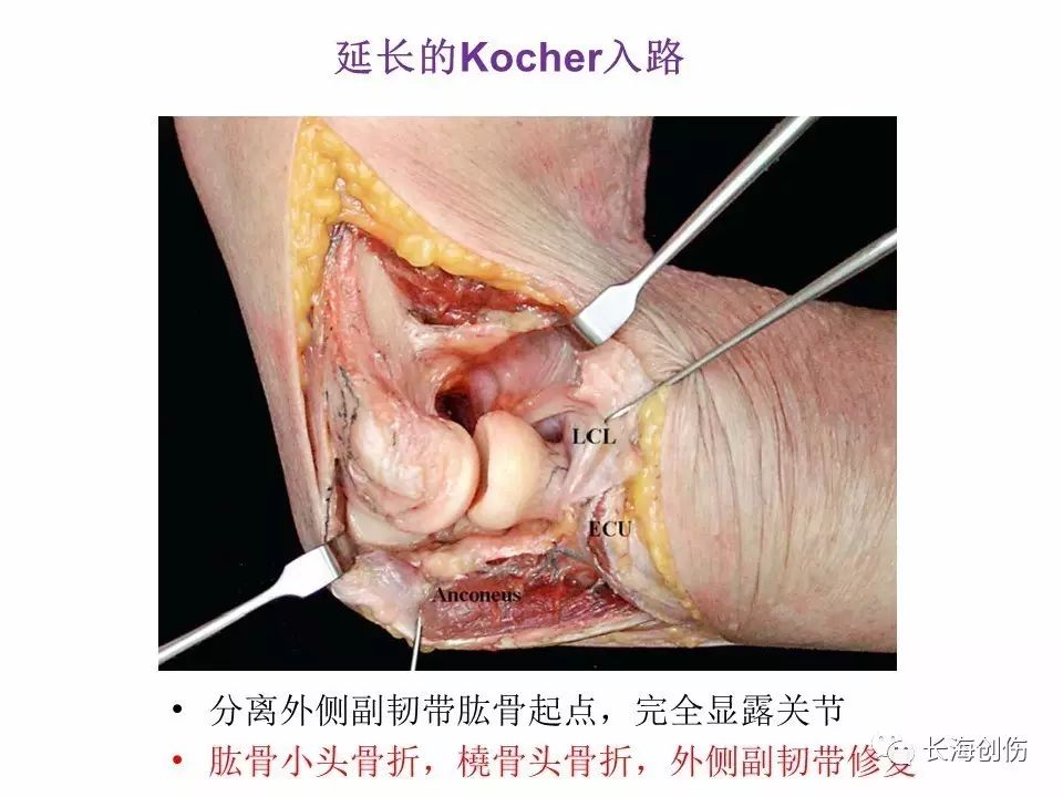 如何做好肘关节手术，先看看这篇解剖和手术入路！