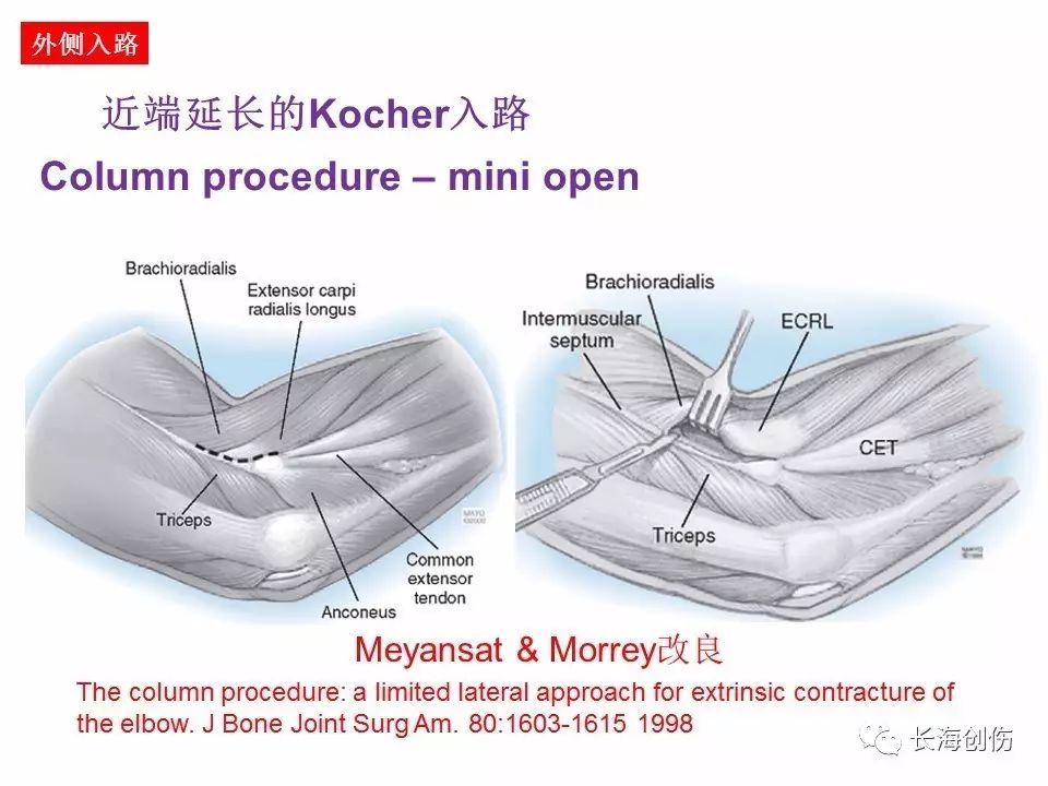 如何做好肘关节手术，先看看这篇解剖和手术入路！