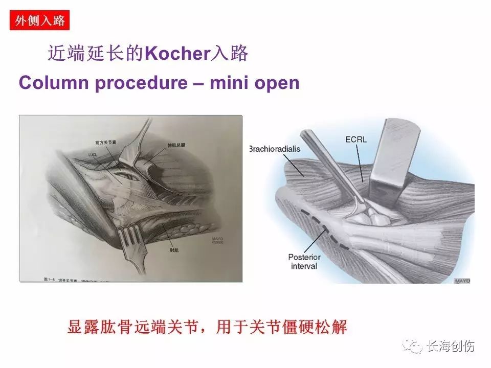 如何做好肘关节手术，先看看这篇解剖和手术入路！