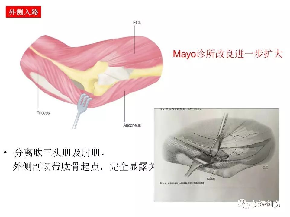 如何做好肘关节手术，先看看这篇解剖和手术入路！