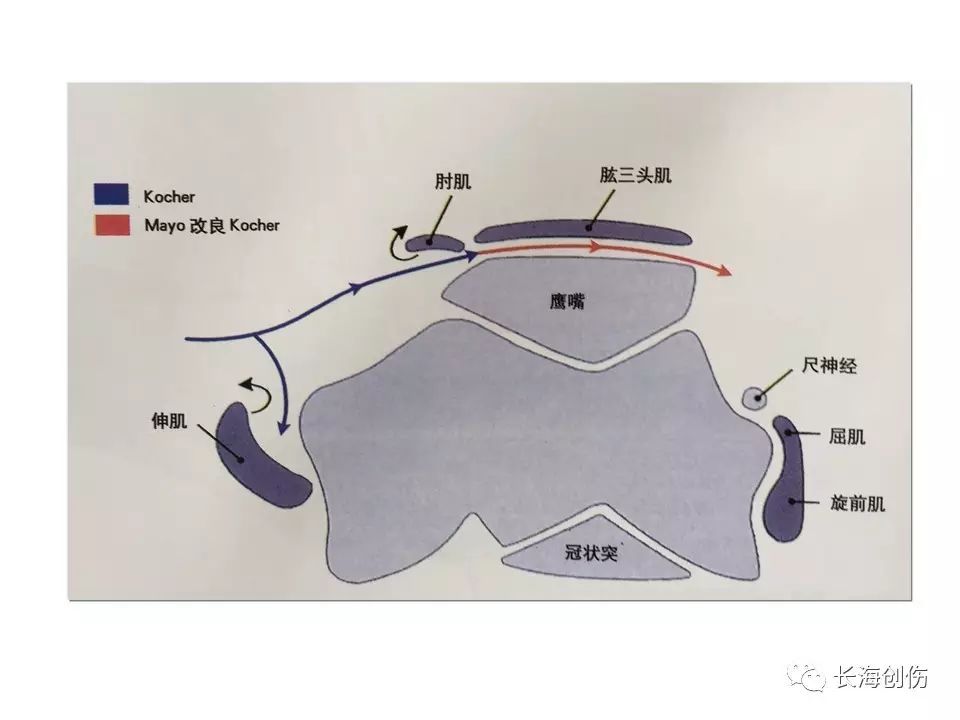 如何做好肘关节手术，先看看这篇解剖和手术入路！