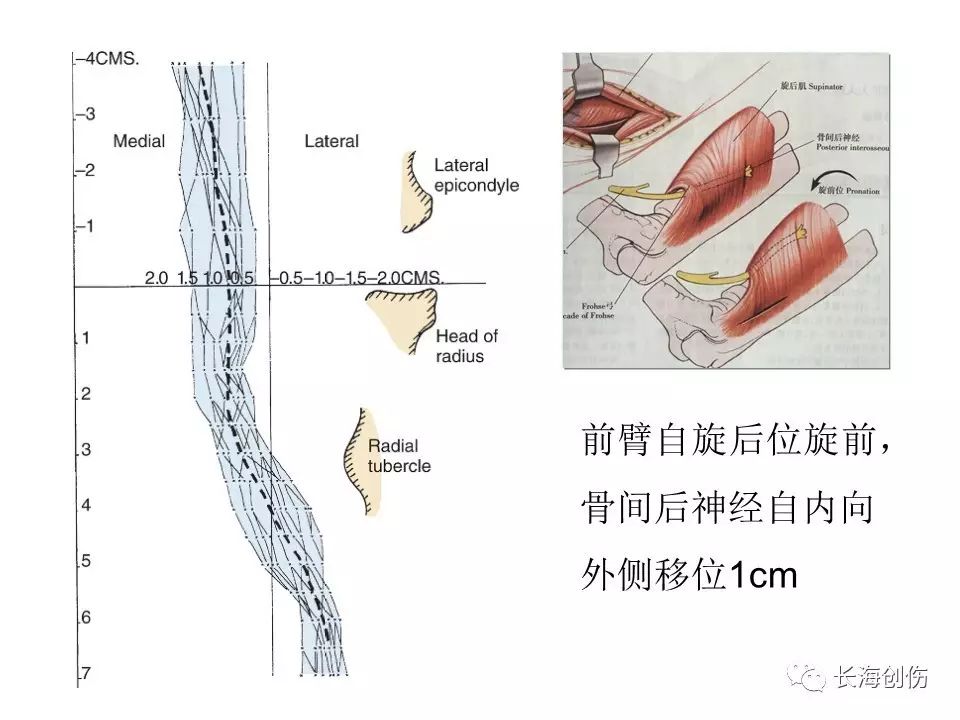 如何做好肘关节手术，先看看这篇解剖和手术入路！