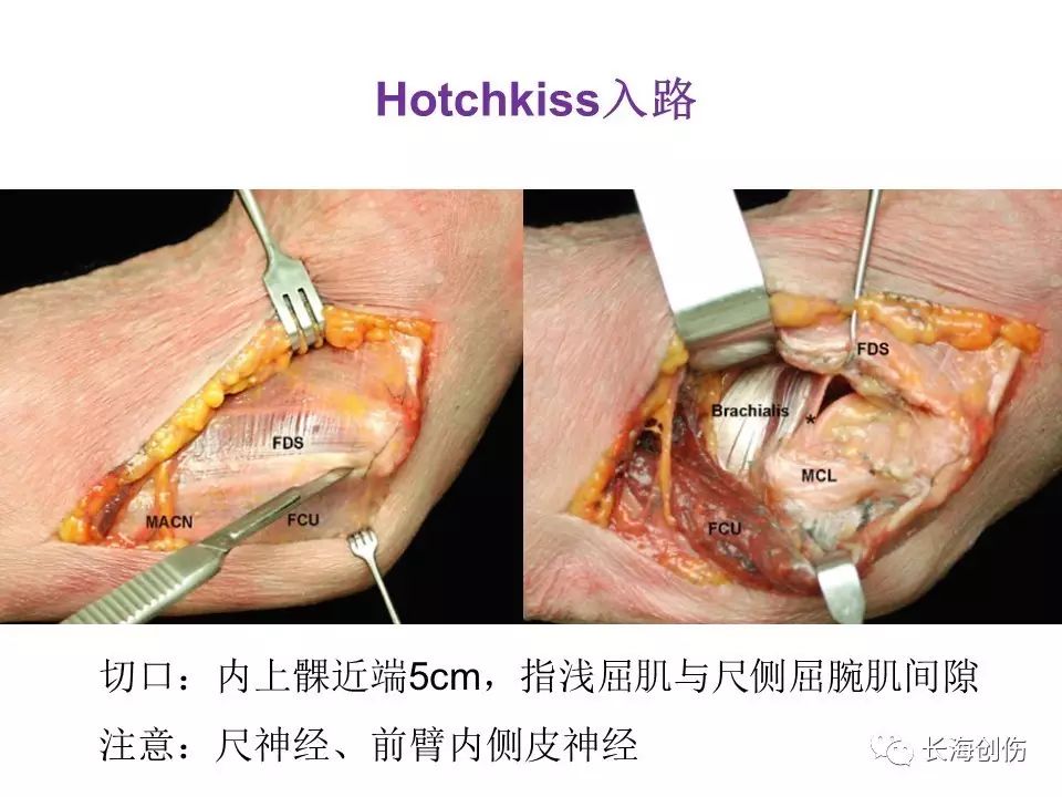 如何做好肘关节手术，先看看这篇解剖和手术入路！