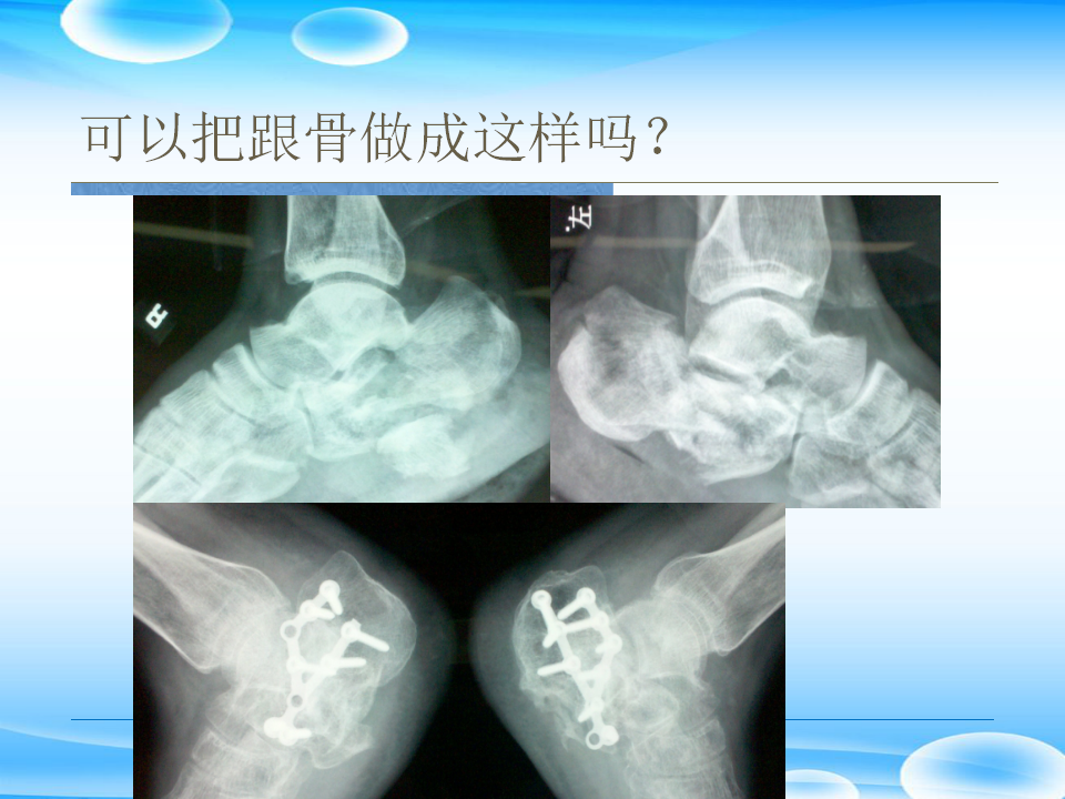 一篇掌握：跟骨ORIF十大手术技巧！