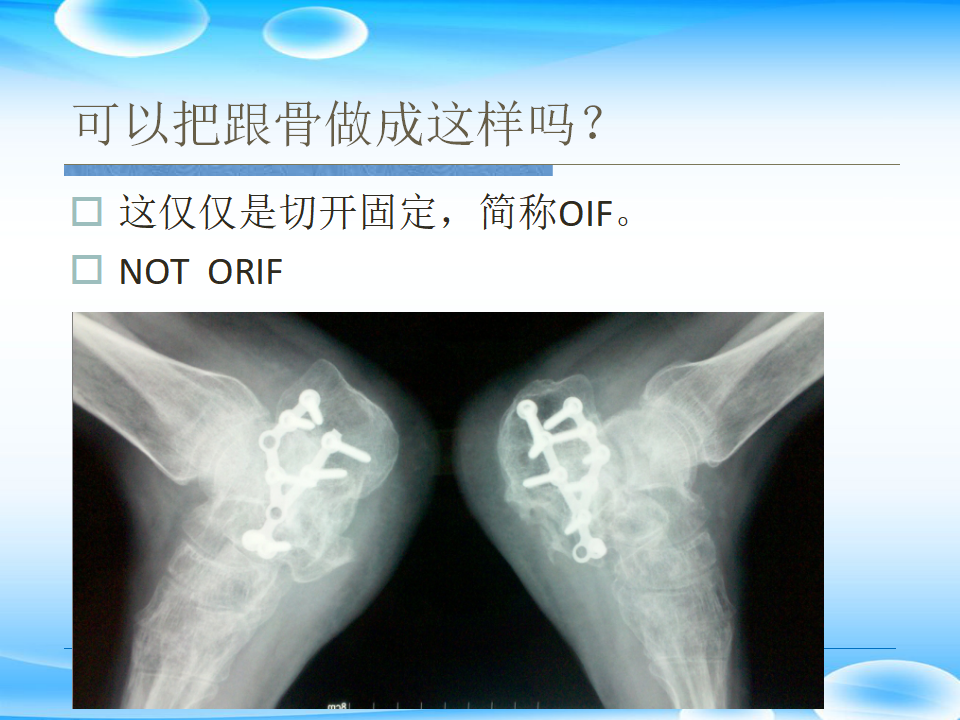 一篇掌握：跟骨ORIF十大手术技巧！