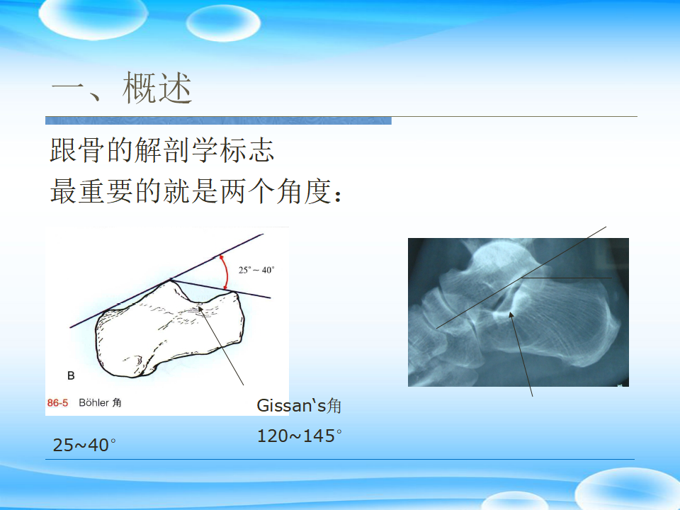 一篇掌握：跟骨ORIF十大手术技巧！