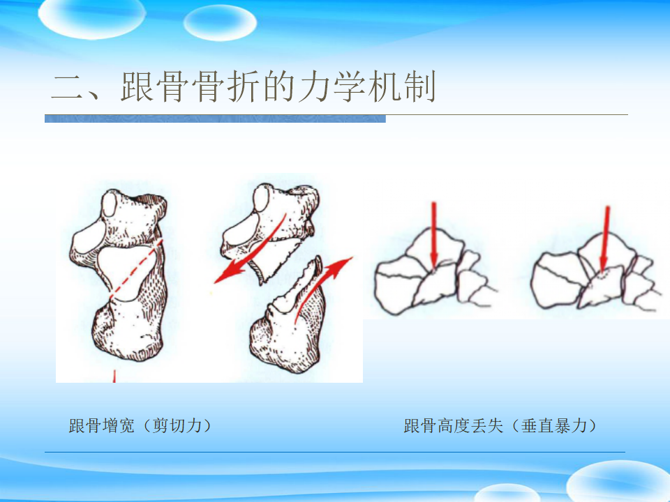 一篇掌握：跟骨ORIF十大手术技巧！