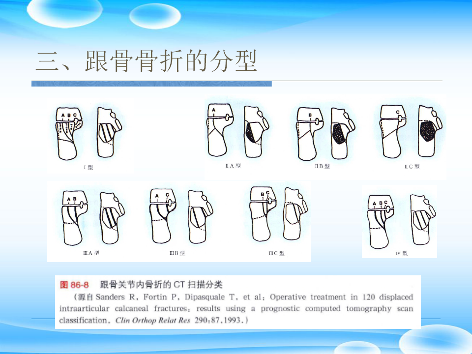 一篇掌握：跟骨ORIF十大手术技巧！