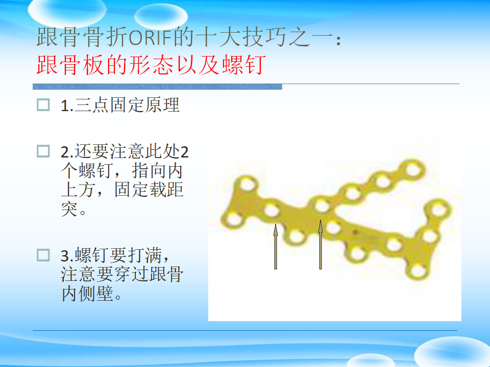 一篇掌握：跟骨ORIF十大手术技巧！