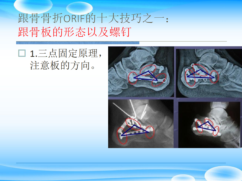 一篇掌握：跟骨ORIF十大手术技巧！