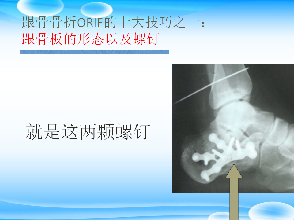 一篇掌握：跟骨ORIF十大手术技巧！