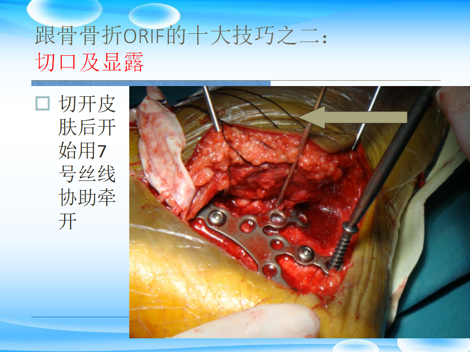 一篇掌握：跟骨ORIF十大手术技巧！