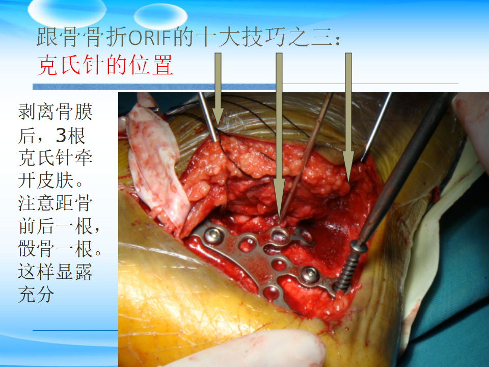 一篇掌握：跟骨ORIF十大手术技巧！