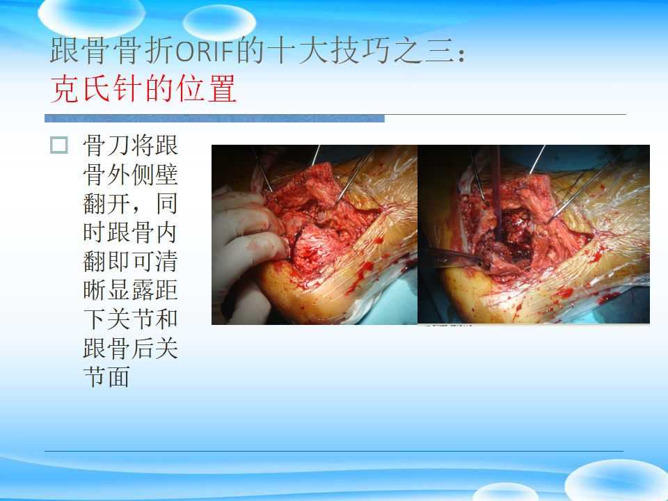 一篇掌握：跟骨ORIF十大手术技巧！