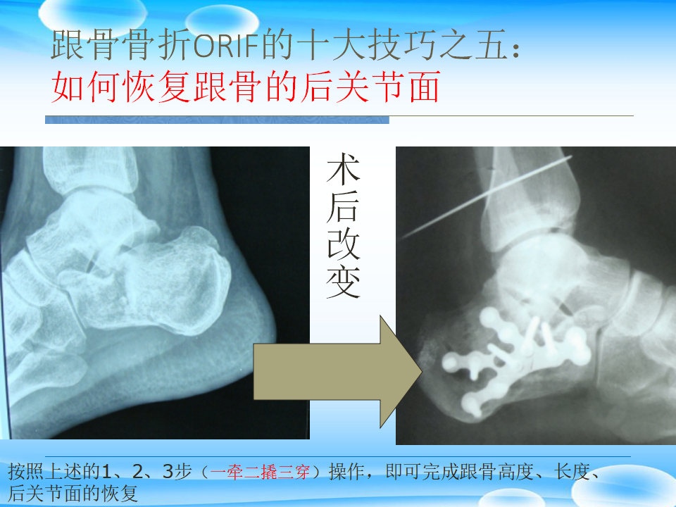 一篇掌握：跟骨ORIF十大手术技巧！