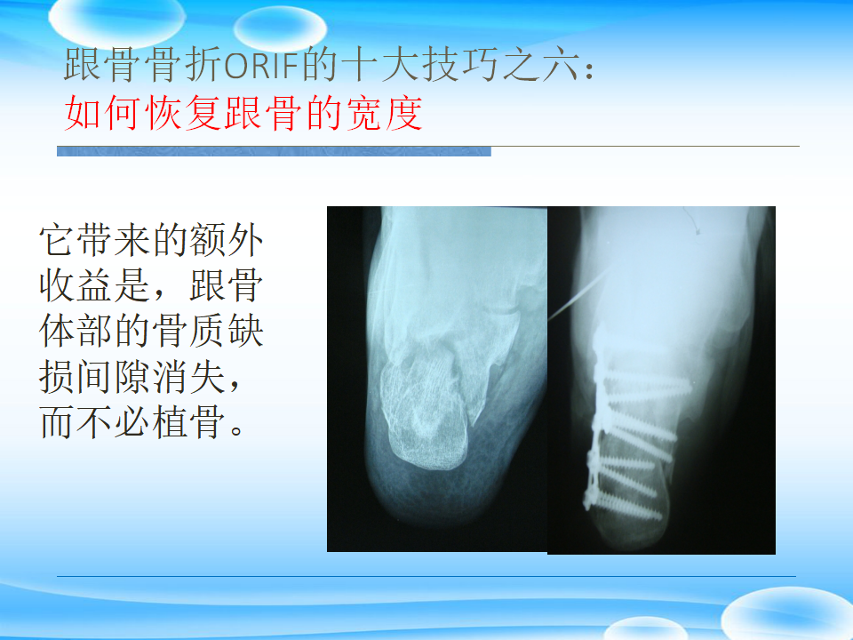 一篇掌握：跟骨ORIF十大手术技巧！