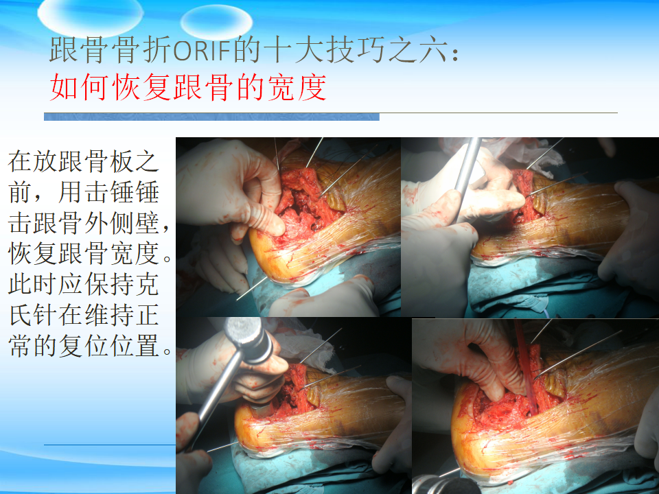 一篇掌握：跟骨ORIF十大手术技巧！