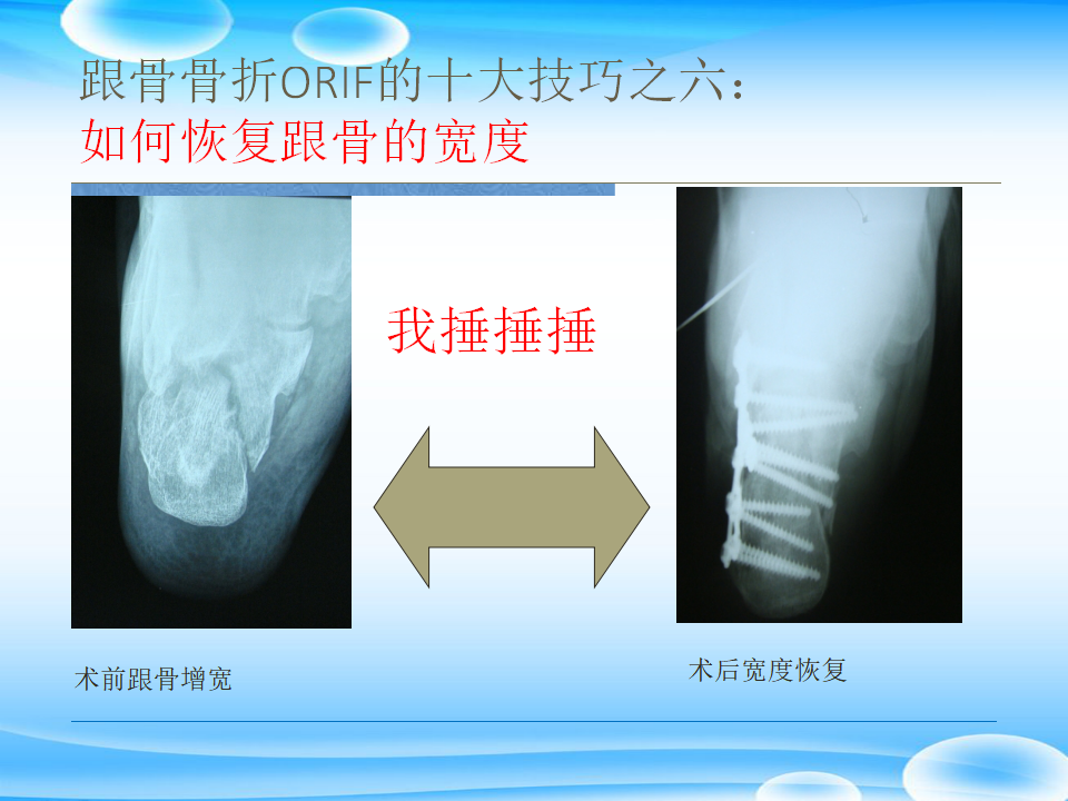 一篇掌握：跟骨ORIF十大手术技巧！