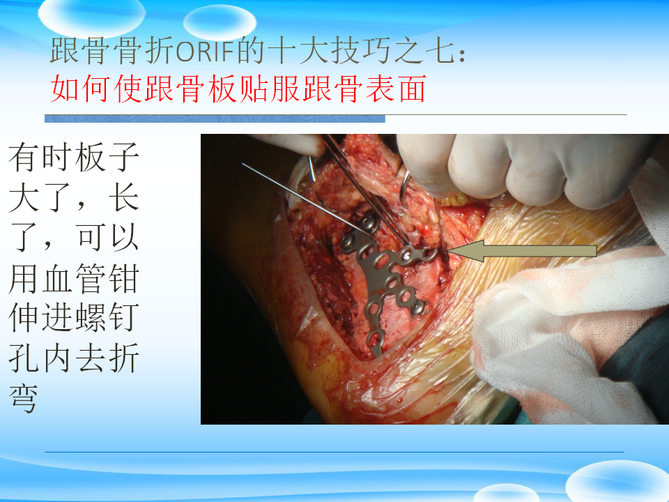 一篇掌握：跟骨ORIF十大手术技巧！