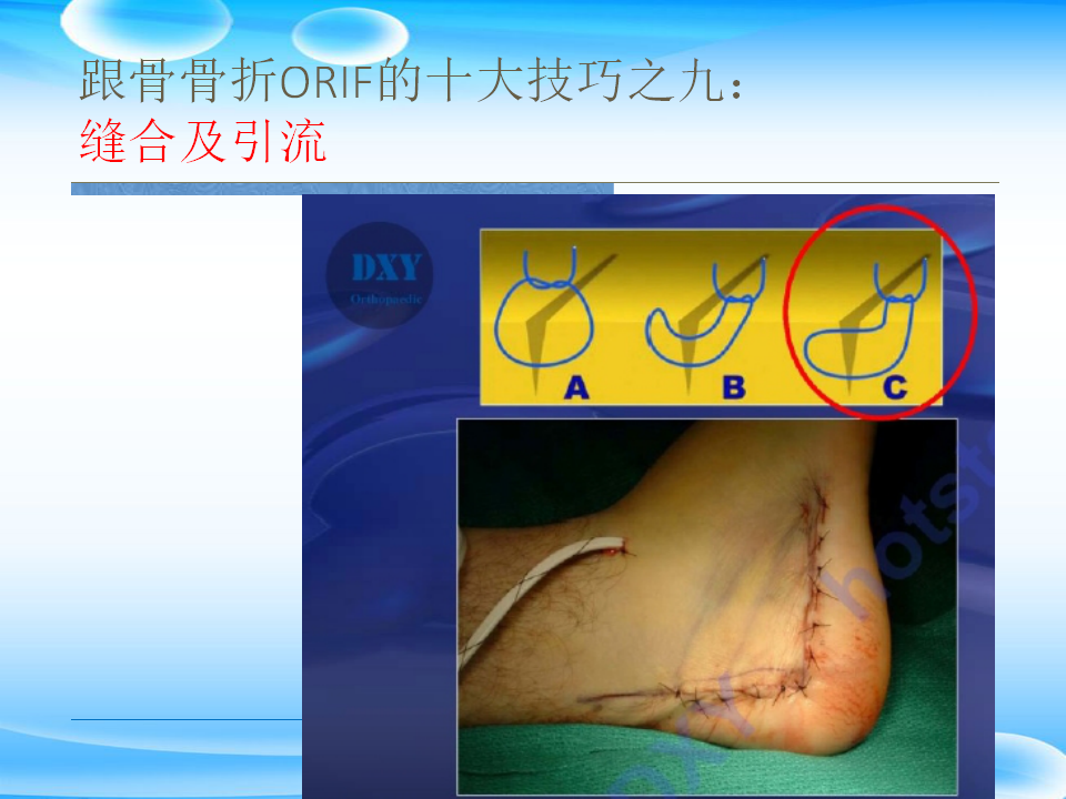 一篇掌握：跟骨ORIF十大手术技巧！