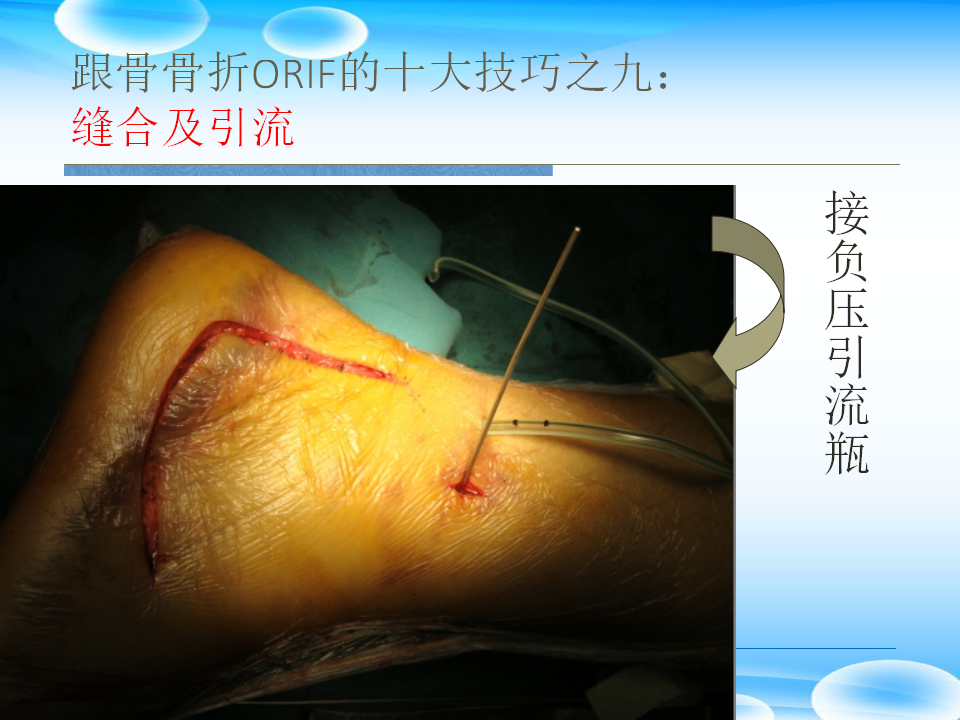 一篇掌握：跟骨ORIF十大手术技巧！