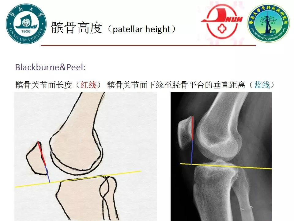 一篇掌握：膝关节X线的基本测量方法