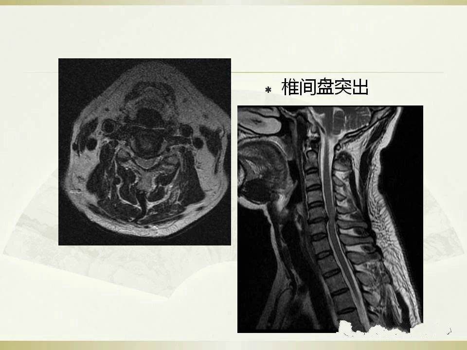 颈椎病的影像学诊断及临床分型汇总